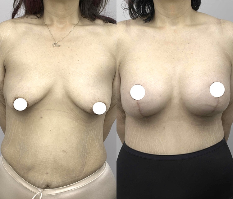 breast lift & augmentation surgery - image 001 - patient before and after - front view