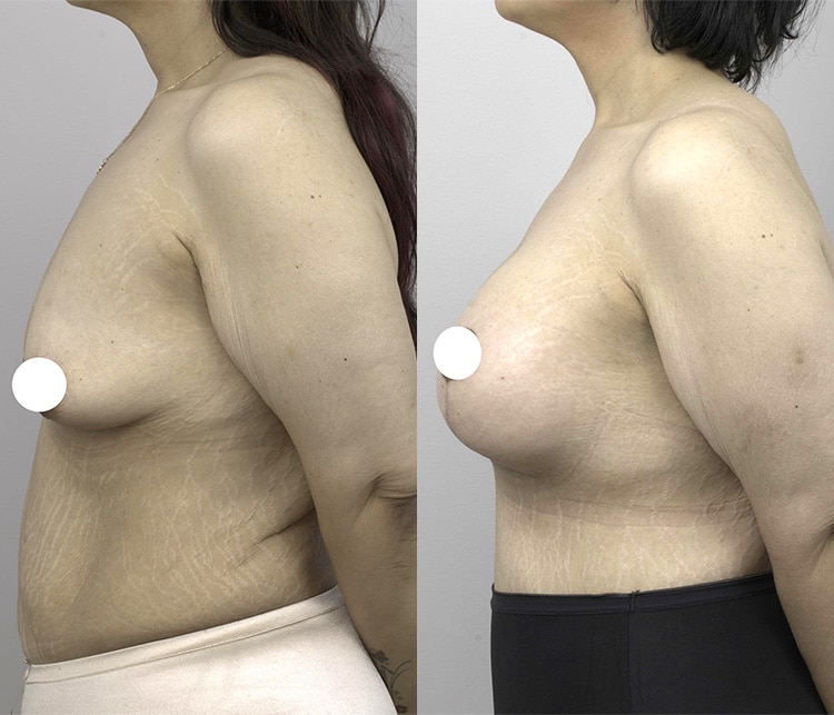 breast lift with augmentation - before & after gallery - image 002 - side view