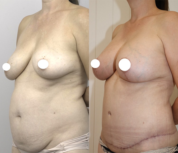 breast augmentation and lift surgery before and after - image 003 - 45 degree view