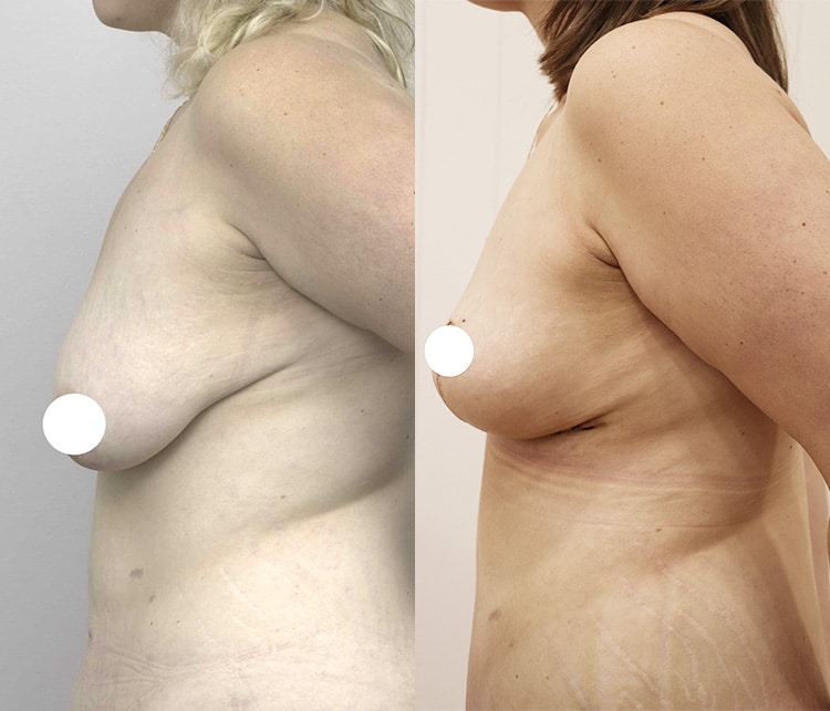 breast lift with augmentation - image 004 - before and after gallery - side view