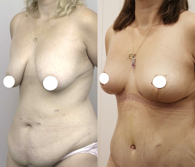 breast lift and augmentation surgery - image 005 - front view