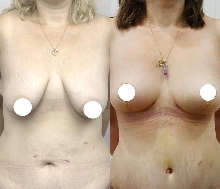 breast lift and augmentation before and after gallery - image 006 - front view
