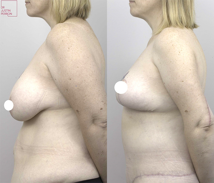 breast augmentation mastopexy before and after - image 007 - side view