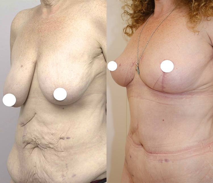 breast lift with augmentation - before and after - image 008 - side view