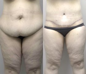 Abdominoplasty_1_BA