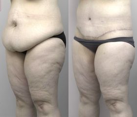 Abdominoplasty_2_BA