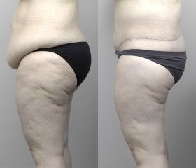 Abdominoplasty_3_BA