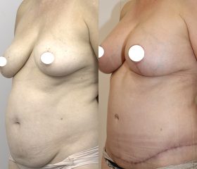 Abdominoplasty_4_BA