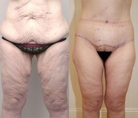 Abdominoplasty_6_BA