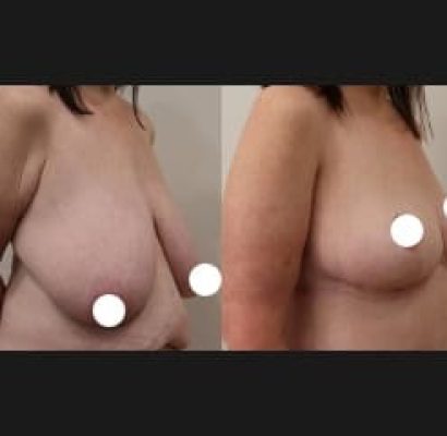 Breast Reduction -1