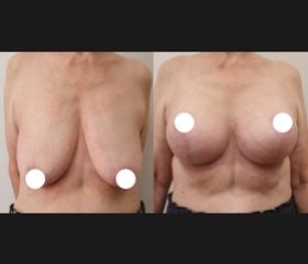 Augmentation Mastopexy 20